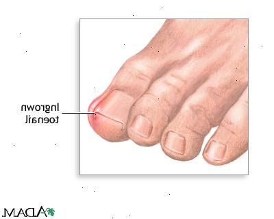 Hvordan at slippe af nedgroede tånegle. Soak din fod i en blanding af varm (eller så varmt som du kan holde det) vand og Epsom salt.
