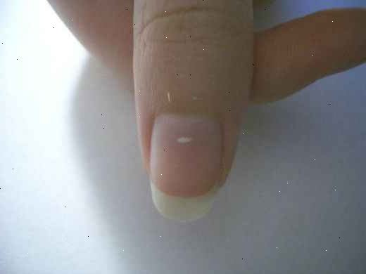 Hvordan man kan slippe af disse hvide pletter på dine negle. Løsningen er simpelthen at lade dem vokse ud.