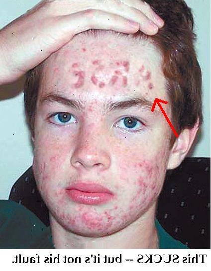 Hvordan man kan slippe af med acne hurtigt. Brug udskiftninger til følsom hud.