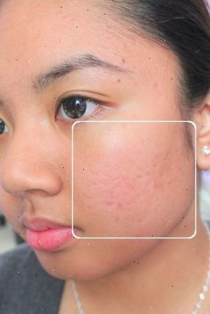 Hvordan man kan reducere forekomsten af ​​ar fra dit ansigt. Slippe af med acne ar med hyben frø olie.