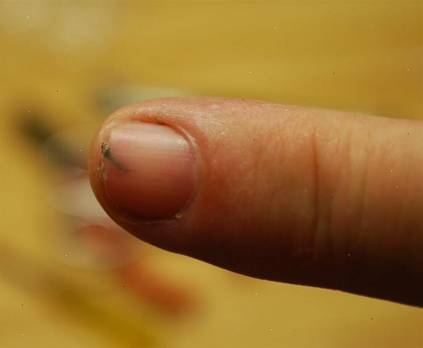 Sådan fjerner du en splint under fingernegl. Tag en medicinsk passende mængde ibuprofen baseret på etiketten information.