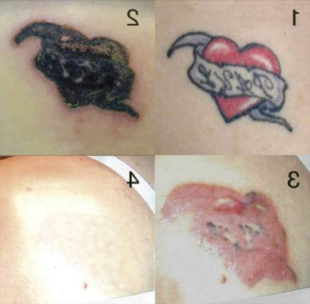 Sådan fjerner du en tatovering. Overveje at få din tatovering fjernet professionelt.
